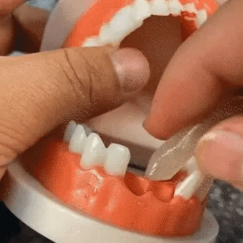 Resina de dientes / Recuperá tu sonrisa en minutos 🦷✨